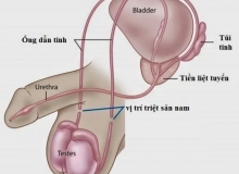 Một số điều cần biết khi triệt sản nam